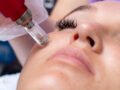 The Ultimate Guide to Microneedling in South Surrey